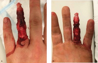 Hand Injury Case: Is it Degloving or Complete Amputation?