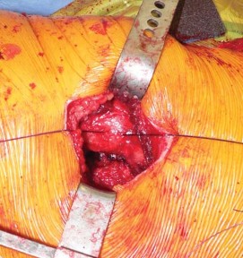Illustration 63 for Exploring the Ambulatory Surgical Setting for Total Hip Replacement