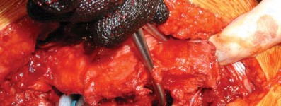 Illustration 53 for S-ROM: Inside the Technique of Modular Implant Design