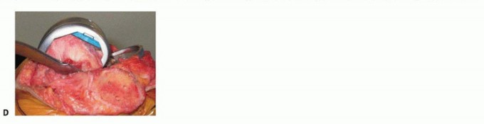 Illustration 11 for Femoral Bone Loss: Metal Augments for Revision Knee Success