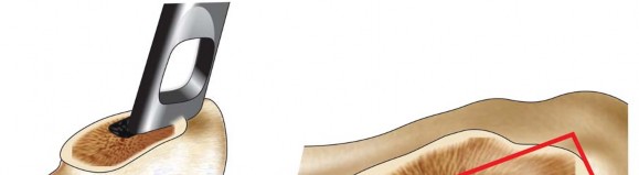 Illustration 11 for Mastering Cementing Technique Femur: A Step-by-Step Guide