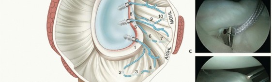 Illustration 4 for Relief for MDI: Expert Treatment of Multidirectional Shoulder Instability