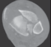 Illustration 26 for Optimizing ORIF for Tibial Plafond Fractures: A Modern Approach