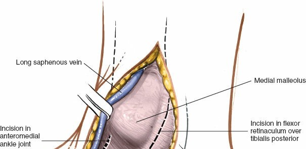 Illustration 5 for Step-by-Step Medial Side of the Ankle Approach Guide
