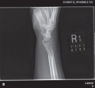 Illustration 2 for Giant Cell Tumor: Understanding Its Aggression Through a Case Study