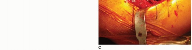 Illustration 15 for The Tapered Stem: Your Guide to Durable Cementless Hip Fixation