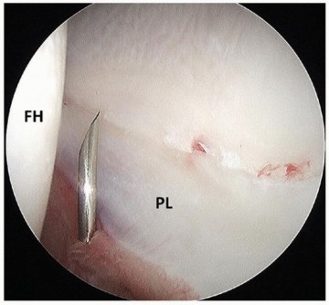 Illustration 14 for Beyond Knee Surg: Hip Arthroscopy for Sports Injuries