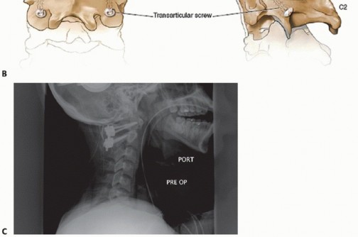 Illustration 12 for Master Techniques for Cervical Fracture Reduction: Type III & More