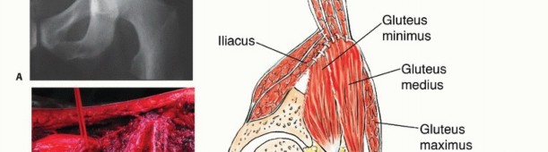 Illustration 50 for Pelvic Metastasis Surgery: A Component of the Utilitarian Approach
