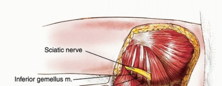 Illustration 9 for Beyond Hemipelvectomy: Preservation of the Sciatic in Buttock Surgery