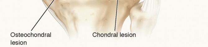 Illustration 3 for Dissecans of the Knee: What's the Difference – OCD vs. AVN?