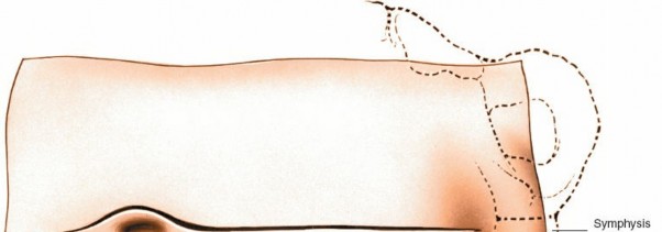 Illustration 57 for Approach to the Lumbar Spine: Mastering Techniques & Anatomy
