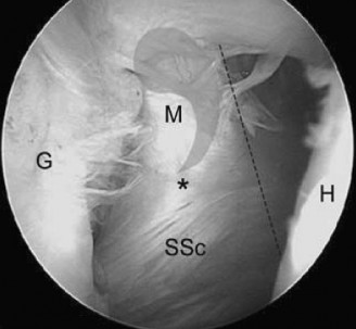 Illustration 12 for Acad Orthop Surg Challenge: Diagnose Shoulder Pain Case 1