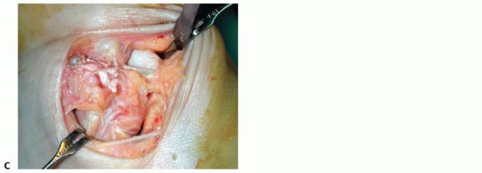 Illustration 49 for Medial Ankle Instability: Find Relief with Reconstruction