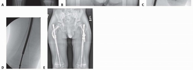 Illustration 25 for Less Pain, More Function: Fassier-Duval Nailing for Osteogenesis Imperfecta