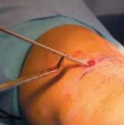 Illustration 14 for Pediatric Tibial Fractures: Avoid Mistakes, Ensure Optimal Healing