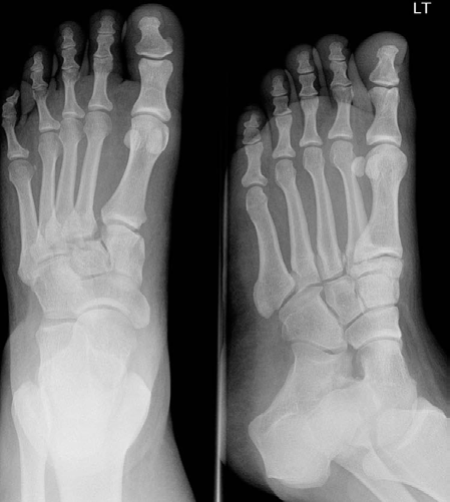 Mastering Lower Limb Trauma: AP & Oblique X-ray Diagnosis