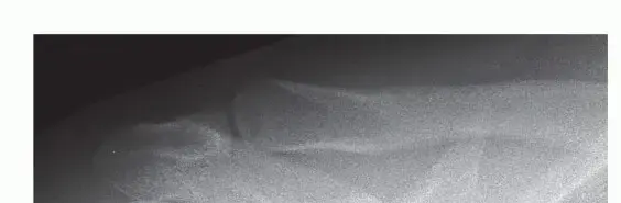 تثبيت المفصل الأخرمي الترقوي بالمنظار: دليلك الشامل لكتف قوي خالٍ من الألم