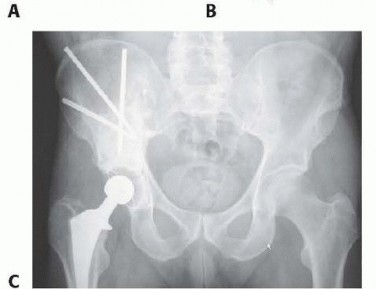 Illustration 7 for Regain Mobility: Total Hip Arthroplasty for Malignant Lesions
