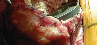 Illustration 36 for Hinged Total Knee: The Salvage Solution for Challenging Cases