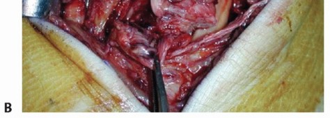 Illustration 19 for Medial Ankle Instability: Find Relief with Reconstruction