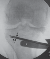 Illustration 30 for Guide Pin Assembly: Key to Flawless Upper Tibial Osteotomy