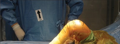 Illustration 3 for Minimal Incision Total Knee: Experience Faster Healing