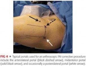 Illustration 107 for Mastering the Scope for Femoroacetabular Impingement