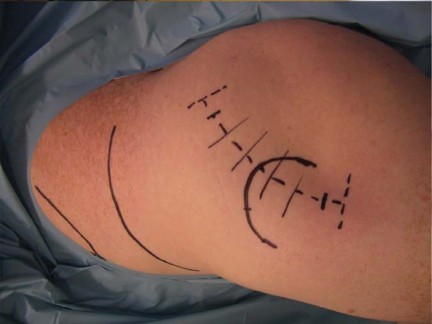 Illustration 46 for Successful Total Hip Replacement in Developmental Dysplasia