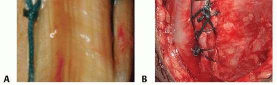 Illustration 37 for Distal Humeral Fractures: When Is Elbow Replacement the Best Option?