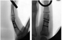 صورة طبية: دليل الأستاذ الدكتور محمد هطيف الشامل لأمراض وإصابات اليد والمعصم في صنعاء