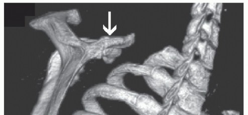 Illustration 6 for Solving Snapping Scapula: Is resection of the superomedial your option?