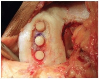 Illustration 28 for High Tibial Osteotomy: Realignment for Lasting Knee Pain Relief
