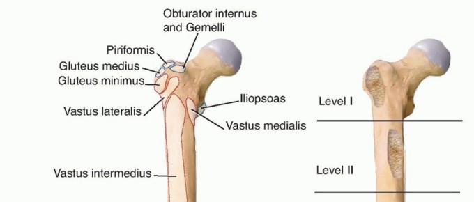 Overcoming Proximal Femoral Bone Loss: Fluted Stems in Revision THA