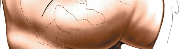 Illustration 175 for Unlocking Every Aspect of the Hip's Surgical Approaches