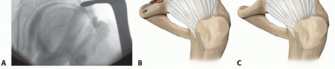 Illustration 10 for Labral Support Shelf Procedure: Preventing Perthes Deformity