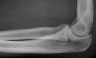 Illustration 5 for Elbow Dislocation Cases: Diagnose, Treat & Manage Effectively