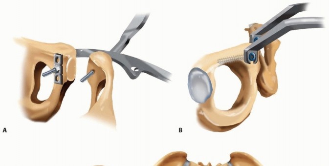 Illustration 17 for Achieve Stable Fixation of the Symphysis: Open Reduction