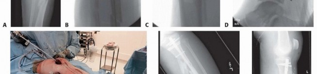 Illustration 30 for Optimizing Intramedullary Nailing for Tibial Shaft Fractures