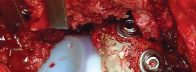 Illustration 28 for Management of Periprosthetic Fractures: An Expert Surgical Guide