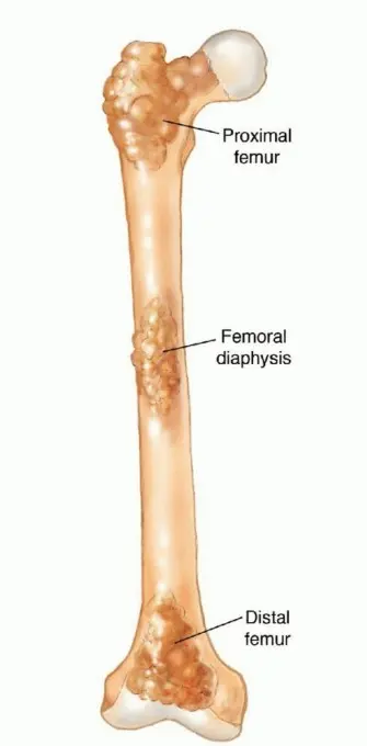 صورة توضيحية لـ النقائل العظمية الفخذية: دليل شامل للعلاج واستعادة الوظيفة مع الأستاذ الدكتور محمد هطيف في صنعاء