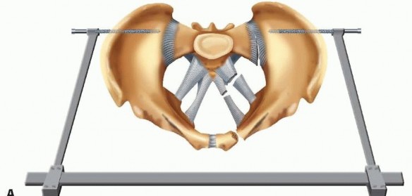 Illustration 10 for Emergency Fixation of the Pelvis: Control Bleeding & Restore Stability