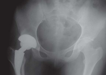 Illustration 47 for Considering METHA Short Stem? Discover Bone-Preserving THA