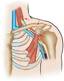 Illustration of outlet syndrome thoracic - Dr. Mohammed Hutaif
