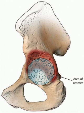Illustration 3 for Uncemented Acetabular Revision: Optimizing Hemispherical Cup Use