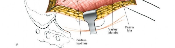 Illustration 177 for Unlocking Every Aspect of the Hip's Surgical Approaches