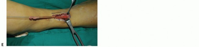 Illustration 47 for Restore Movement: Tendon Transfer for Common Peroneal Nerve Foot Drop