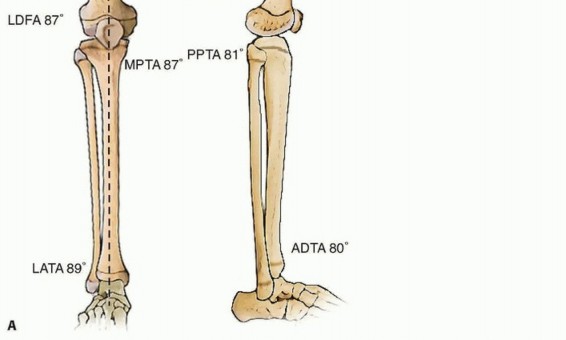 Illustration 2 for Optimizing Growth to Correct Pediatric Limb Deformities