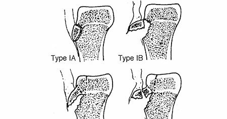 Illustration 28 for Master Pediatric Femoral Shaft & Knee Fractures: Interactive Module