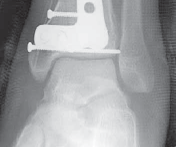 Illustration 49 for Optimizing ORIF for Tibial Plafond Fractures: A Modern Approach